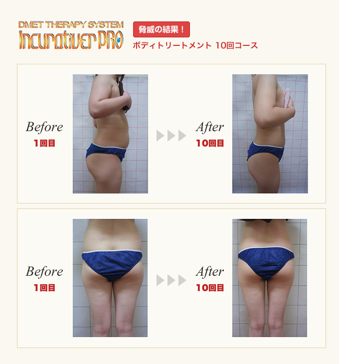 DMET THERAPY SYSTEM Incurativer PRO ボディトリートメント 10回コース